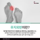 레푸스 경대점 이미지