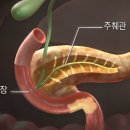 췌장암 발병 위험 요소와 진단 방법 이미지