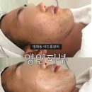 방화동 피부관리 남자성인 여드름 잘 잡는 곳 영인피부 후기