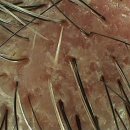 [구로,양천,가산 두피탈모관리 스칼프데이]지루성피부염과 탈모관계 이미지