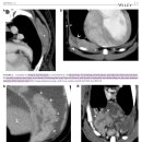 CT를 통해 흉수가 종양성인지, 염증성인지 구분할 수 있을 것인가? mesothelioma 감별의 impression 이미지