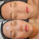 러블리여나 | 광주에스테틱 러블리여나 슈퍼젝션 유지기간