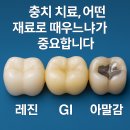 레진, GI, 아말감 차이점? 충치 때울 때 꼭 알아야 할 치과 재료 정리