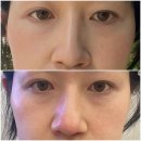 코조각주사 콧볼보톡스 3회까지 받아 본 변화 비교 내돈내산 후기