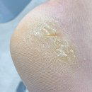 굳은살 | 가평읍 남자 발뒤꿈치 갈라짐 해결한 후기 (골프 굳은살)