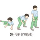 듀시엔형 근이영양증 (Duchenne Muscular Dystrophy) 이미지