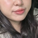 또팔자 | 부산 팔자주름,심부볼제거 울쎄라 리프팅 후기 (주기)