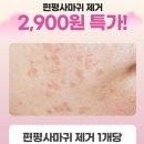 홍피부과의원 | [오늘의 일상] 홍대 밴스의원 흑자 리팟레이저, 편평사마귀, 비립종 제거 내돈내산 후기💉