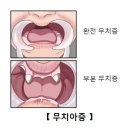 무치아증(Anodontia) 유전질환이란? 이미지