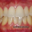 우면본치과의원 | 🦷 [양재 우면동 과천 치과] "앞니 하나만 까맣게...신경 죽은 치아, 크라운 없이 하얗게 되돌린 후기