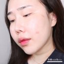 강남역 갤러리 힐링아트피부과 슈링크유니버스 300샷 솔직후기