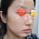 용인미하나의원 | 용인미하나의원 피부과 잡티 시술 비용 정리