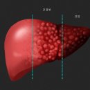 간암 환자 10%는 ‘C형간염’이 원인…대처법은? 이미지