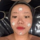 서윤피부샵 | 명동 피부관리샵 서윤피부맑음 3D 윤곽관리 / 울쎄라 시술 후기