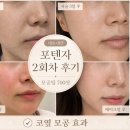 제2금란교 앞 | [공지] 포텐자 2회차 내돈내산 후기 모공팁 700샷 코옆 모공 효과와 7일 변화
