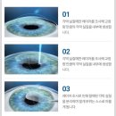 전대약국 | 광주안과 신세계점 전역 후 라식수술을 위한 정밀검사 및 수술 이후 과정