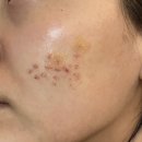 시전 | [내돈내산] 패인흉터 이별기/패인흉터 치료/서브시전 후기 1