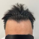 일러스라인 | 신림 두피문신 통증 부작용 직접 받은 후기