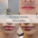 양이멍이 | 대구 입술필러 입꼬리보톡스 잘하는 곳 솔직후기