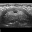Thyroglossal duct cyst 이미지