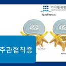 ◎서대문구 척추관협착증 치료는 척추협착 풍선 확잘술로◎ 이미지