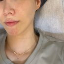 블루워터클리닉 | 선릉 피부과 워터밤 주사 스킨부스터 촉촉 후기