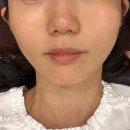 청담동 | 청담동 피부과 티타늄 리프팅 80kj 후기 ✨