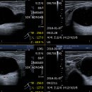 r/o Ganglion cyst. 이미지