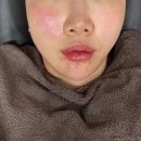 센텀 휴 | 센텀 피부과 온다리프팅 인모드 효과 후기 리뷰