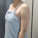 평생 다이어트식 | 전주다이어트 후기 팔뚝지방흡입 후 운동 병행 달라진 일상