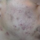 (주)리체 | 여의도 여드름 한의원, 리체안한의원 6개월 솔직 후기
