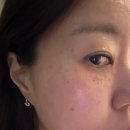 (주)성지 | 부천 편평사마귀 성지 무한제거 내돈내산 후기