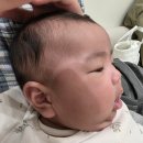 원케어텍 | 다산 아이앤힐성형외과 * 80일 아기 스킨텍제거 수술 후기