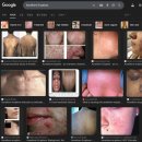 리페어필드(Repair Field) | 흉터 치료에 사용되는 프락셀 레이저