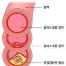 ﻿심장질환과 고지혈증 이미지