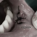 레이크치과의원 | [안산레이크치과] "입술에 혹이 생겼어요" 점액낭종 제거 과정