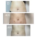 (주)라본브아 | [갸름주사] 강남 복부지방분해주사 3회차 전후 솔직후기 (feat. 식단, 운동, 몸무게변화, 효과 등)