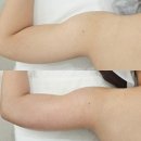 신월동187 | [신월동피부관리/비비에스테틱]팔뚝고민해결하러 신월동신부관리잘하는 비비B&amp;B에스테틱