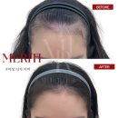 선헤어라인 이미지