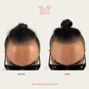 TMW 탈모왕수원 이미지