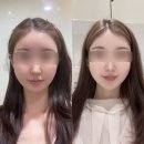 더웨이성형외과의원 | 더웨이 윤곽주사 전후 내돈내산｜소개팅주사 + 온다리프팅 6만줄 솔직 후기