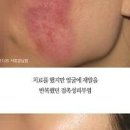 몸에 붉은 반점 몸에 생기는점 피부 붉은반점 생기는 이유 낫는법 이미지