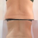 참이화약국 | 울산 빼라피네오 여름휴가 준비 필수 복부 전후 처진 뱃살 라인 정리 실제 변화