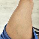 브이웰마취통증의학과의원 | 베나실 시술후기! -대구 브이웰마취통증의학과