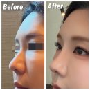 고든몸한의원 | 코성형 대안 콧대 높이는 법 | 코실리프팅 리얼 후기(통증, 다운타임, 회복과정)