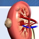 신장암(Kidney Cancer) 이미지