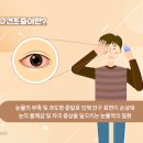 질건조증 증상 및 원인과 치료 : 영양제 이미지