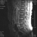 ^^ mri 판독좀 해주세요..도움을 부탁드려요... 이미지