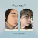 300 | 부산 해운대피부과 올리지오후기 300샷 가격 효과 전후 내돈내산