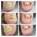 동두천무좀발톱 오래된 전문샵 방문 후기 네일애반하다 네일 아트 내성발톱 무좀 발각질 문제성발